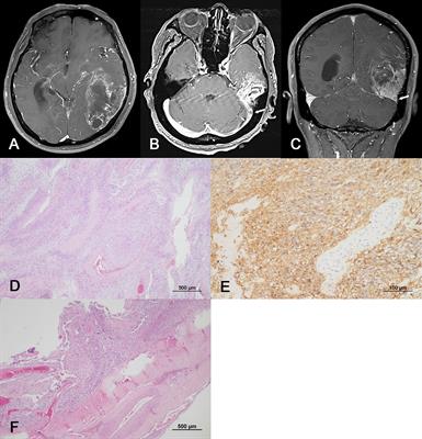 Case report: Fulminant extraneural metastasis of glioblastoma through venous sinus